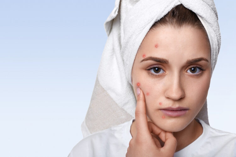 Pimple Treatment in Ayurveda Sharjah