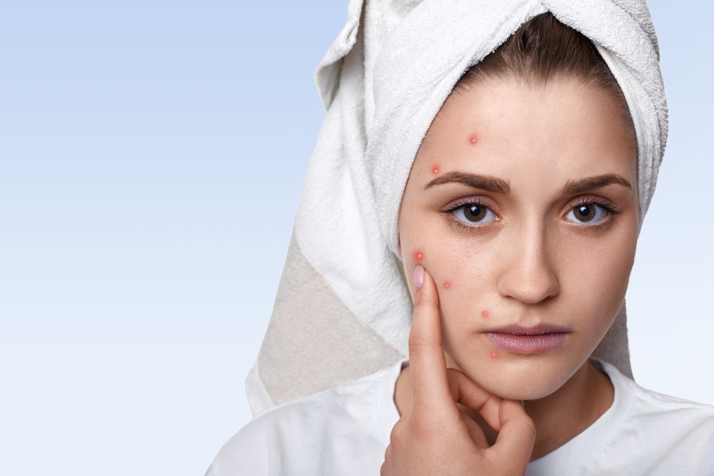 Pimple Treatment in Ayurveda Sharjah
